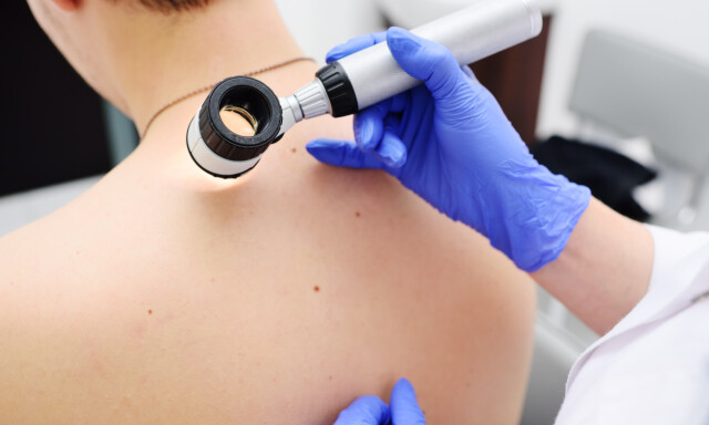 DERMATOSKOPI: Legen kan undersøke flekkene med et dermatoskop - som er en type mikroskopundersøkelse av huden med kraftig forstørrelse. FOTO: NTB Scanpix / Shutterstock / Evgeniy Kalinovskiy DERMATOSKOPI: Legen kan undersøke flekkene med et dermatoskop - som er en type mikroskopundersøkelse av huden med kraftig forstørrelse. FOTO: NTB Scanpix / Shutterstock / Evgeniy Kalinovskiy